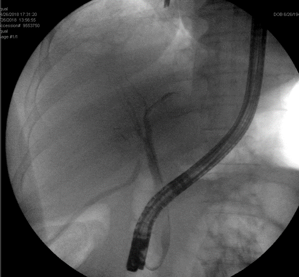 Figure 1. ERCP cholangiogram performed when bilious drainage was visualized post cholecystectomy from the JP drain in the gallbladder fossa. 