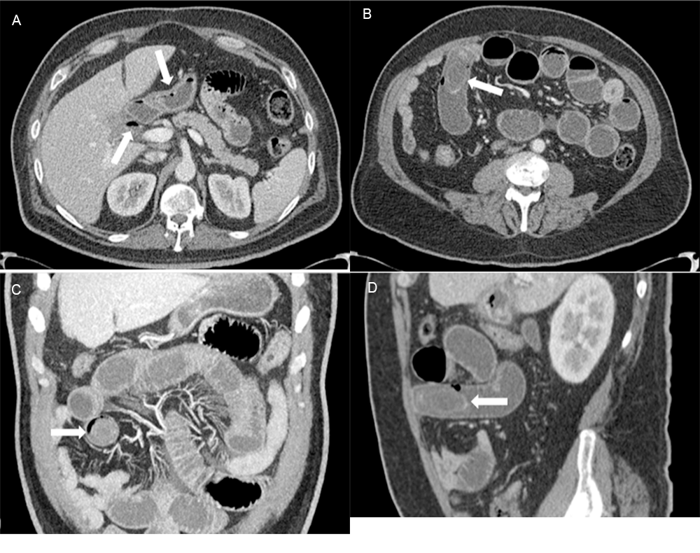 A) Perforated gallbladder with air-fluid track extending to duodenal bulb/gastric antrum. B) Axial view; C) coronal view; and D) sagittal view of gallstone.