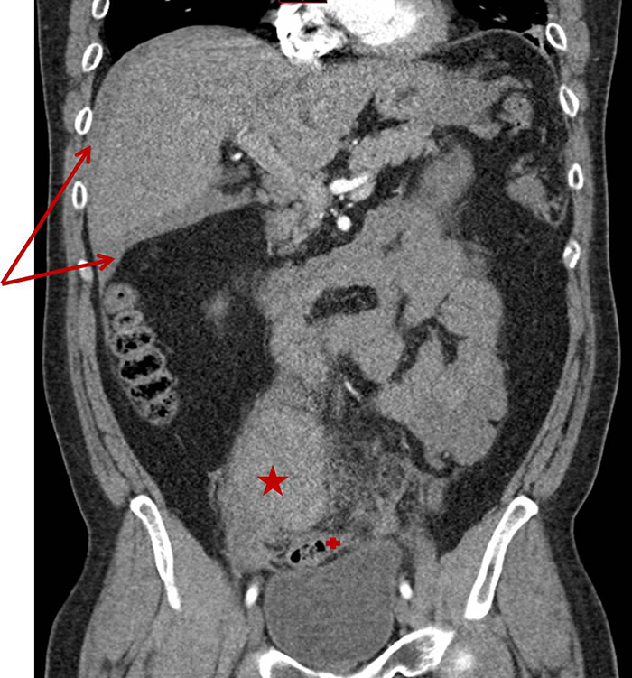 Figure 1. Figure 1a-b. CT demonstrating hemoperitoneum (arrow) and large clot (*) abutting the sigmoid colon (+).