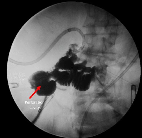 Contrast outlines a contained perforation cavity with free flow into the proximal and distal duodenum. No contrast extravasation is observed