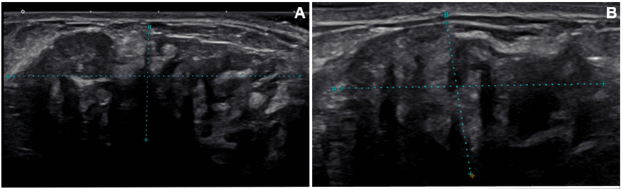 A) Right breast retro areolar 6:00 antiradial view ultrasound with indistinct 4.21 × 1.57 cm hypoechoic region. B) Left breast 6:00 retro areolar view ultrasound with ill-defined 2.92 × 1.71 cm heterogeneous mass.