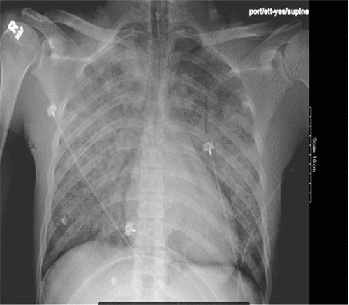 B) Repeat CXR one hour later reveals marked bilateral pulmonary edema consistent with NPE