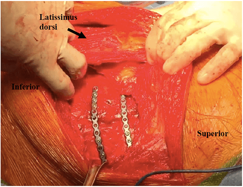 Figure 5: The image depicts the fully spared latissimus dorsi muscle from the thoracotomy procedure. The two sets of plates were placed in order to reduce and fixate left lateral rib fractures of 4 and 5, which manifested in a clinical flail chest. Not pictured are similar plates, inferior to the latissimus dorsi muscle, which reduced and fixated lateral fractures of left ribs 6 and 8 as well.