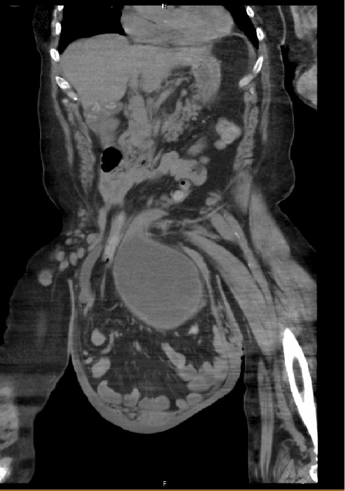 A) Bladder, small intestine, large intestine, and both ureters are herniated and located within the scrotal sac