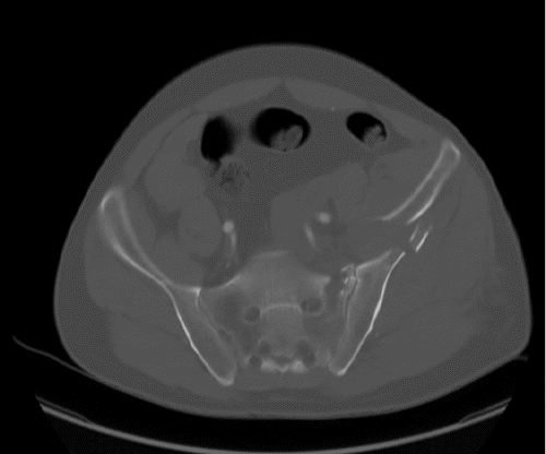 A) Axial View
