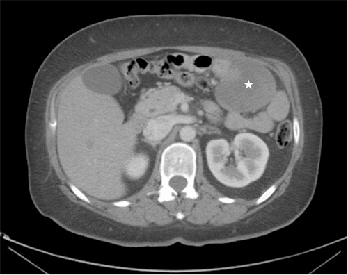 Horizontal view (★tumor)