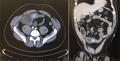 Figure 1a. Sagittal CT Scan image of fecalith causing small bowel obstruction. Figure 1b. Coronal CT Scan image of fecalith causing small bowel obstruction with view of gallbladder.