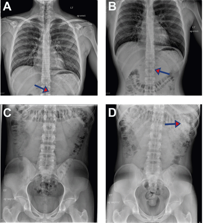 On initial CXR, the lungs were found to be clear with no infiltrate, edema, or effusion, and the heart and mediastinum were within normal limits. A needle measuring approximately 41 mm was visualized (A-B, arrow) shortly after presentation and presumed to be in the stomach. KUB shortly after revealed no dilated bowel or obstruction, organomegaly, fracture, or abdominal calcification, but did reveal the needle in the left upper quadrant, presumably moved into the distended stomach or within the duodenum (D)