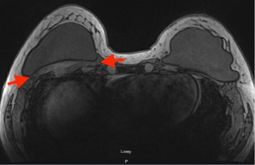 A) Axial T2-weighted MRI scan at two months post-cryoablation shows a decrease in size of the desmoid tumor to 8.9 × 8.2 × 1.9 cm