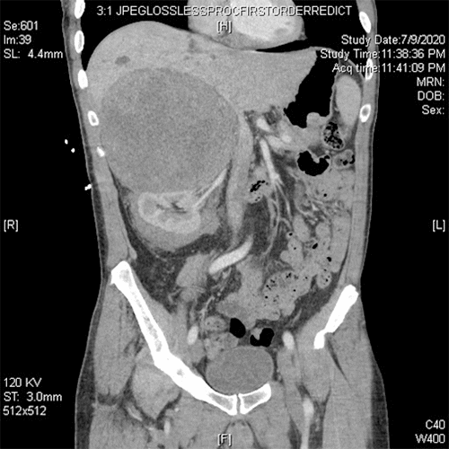 A) Preoperative CT scan displaying a large right-sided adrenal angiosarcoma