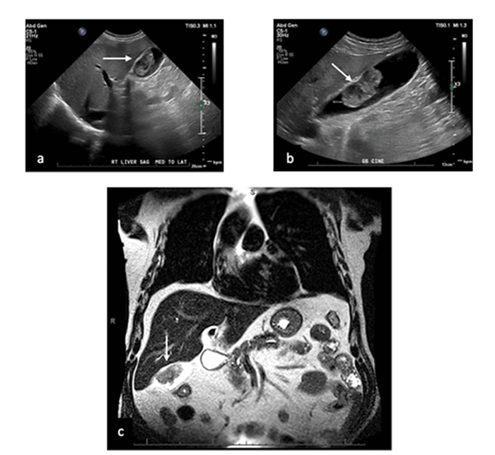 (A, B) Abdominal ultrasound images demonstrating an intraluminal, polypoid mass within the gallbladder, which prompted further investigation. (C) Coronal T2-weighted MRI of the abdomen further characterizing the gallbladder mass. The image shows the 5.0 × 2.6 × 4.3 cm intraluminal lesion adjacent to the superior gallbladder wall
