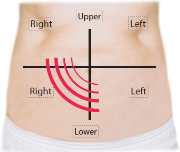 Appendectomy