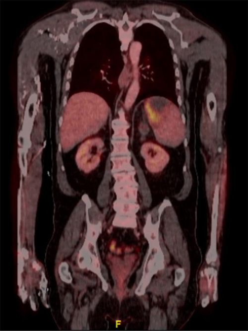 Scan shows hypoenhancing bilobed splenic lesion with rim of intense hypermetabolism in its medial aspect consistent with metabolically active tumor.