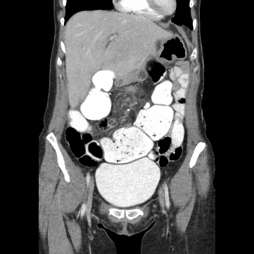 Figure 2. CT scan showing a dilated pouch and small bowel, proximal to the site of torsion (2018)