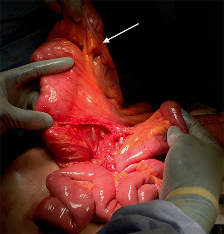 Figure 3. Note the ability of the small bowel mesentery to be elevated out of the abdomen. The cecum and appendix can be seen in the top of the screen (arrow), freely elevated with no surgical mobilization necessary.