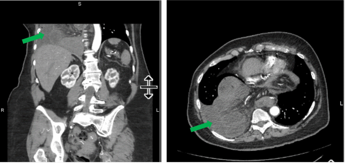 (A) Coronal CT image demonstrating the patient's right diaphragmatic hernia (green arrow indicates herniated bowel). (B) Axial CT image demonstrating the patient's right diaphragmatic hernia (green arrow indicates herniated bowel)