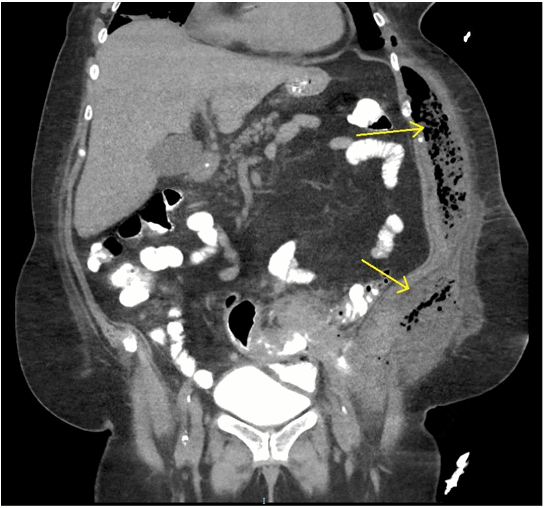 Figure 1. Inflammatory changes about the sigmoid colon with a fistulous connection to the left lateral abdominal wall with a large collection of air, fluid and likely fecal material (yellow arrows).