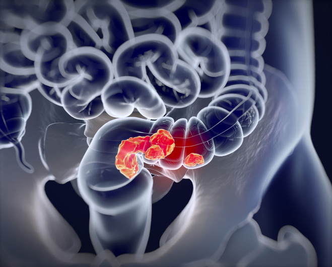 Webinar Will Highlight Operative Standards for Cancer Surgery in Rectal Cancer