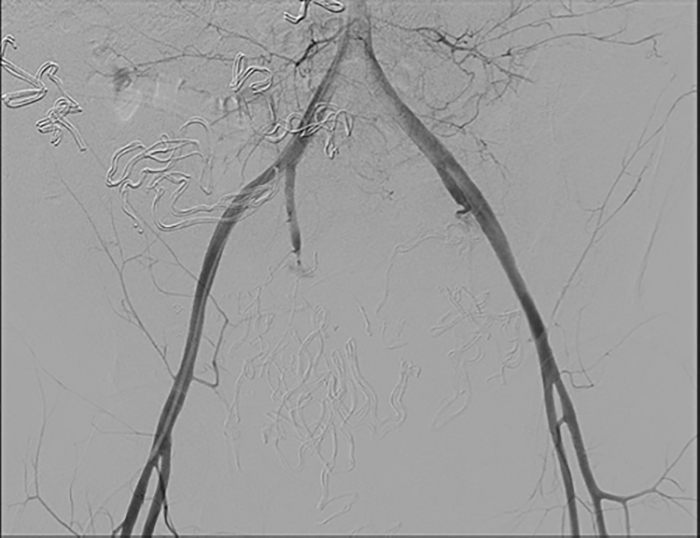 Stabilization of hemodynamics shows extravasation of contrast from bilateral internal iliac artery and absence of contrast enhancement distal to these points.