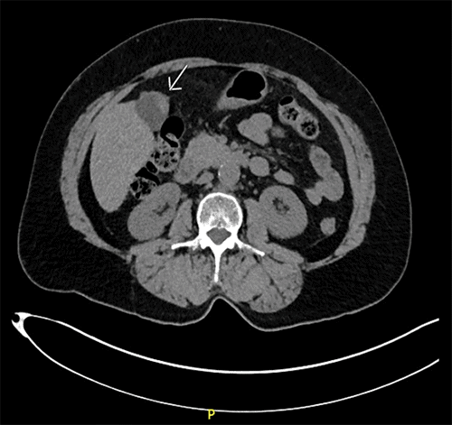 (A) Axial CT image demonstrating focal thickening of the gallbladder wall without pericholecystic stranding