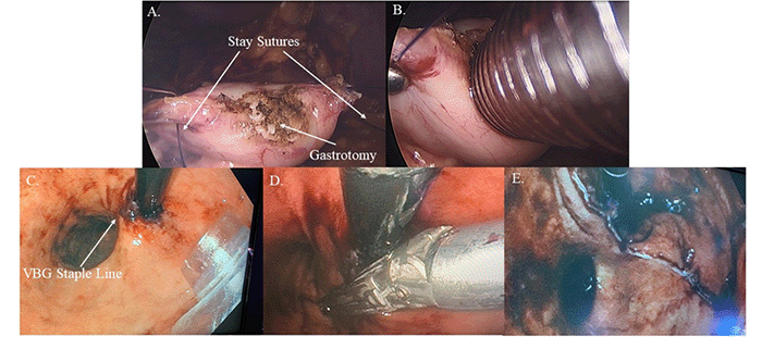 A) Gastrotomy performed following the addition of two stay sutures; B) insertion of the balloon trocar into the stomach; C) visualization of the VBG staple line following insertion of the intragastric balloon trocar; D) insertion of surgical stapler along previous staple line using retroflexed endoscopic view; E) successful transection of previous VBG staple line.