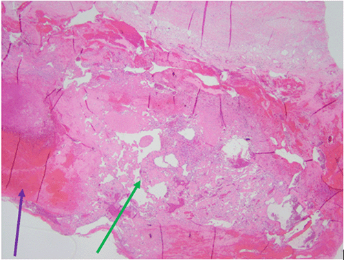 Green arrow: atypical endothelial cells; Purple arrow: adrenal hematoma. Note similarities to an aged adrenal hematoma