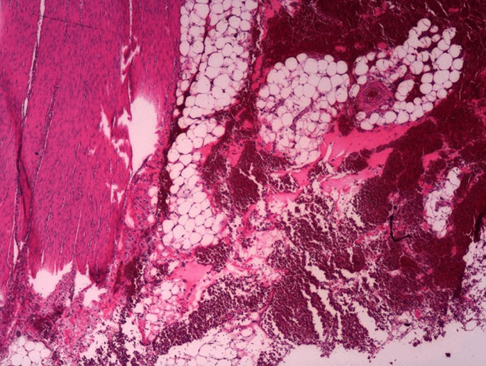 Figure 2. Histology demonstrating hemorrhage within the subserosa.