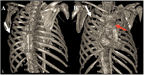 Figure 1: The images above depict three-dimensional renderings of the patient’s axial skeleton adapted from CT scan. The white arrow in A shows lateral fractures to left sided ribs 6,7,8, which were reduced and fixated during surgery with titanium plating. The white arrow in B shows right sided anterolateral rib fractures to ribs 2 and 3, which were also reduced and fixated during surgery using titanium plating. The red arrow in B depicts the large disunion of the manubrium and sternal body from one another, which was reduced and fixated using titanium plating through sternotomy.