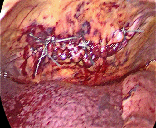B) Defect Closure