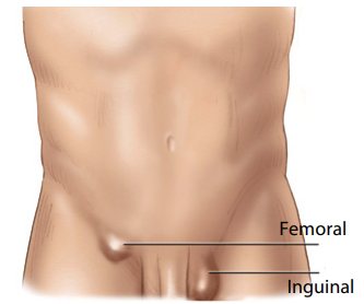 Inguinal and Femoral Groin Hernia Repair