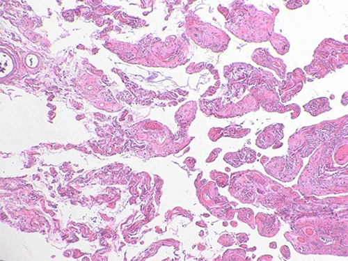 C) 10x: Ropey collagen was present diffusely throughout tumor, distinct pathologic finding in spindle cell lipomas