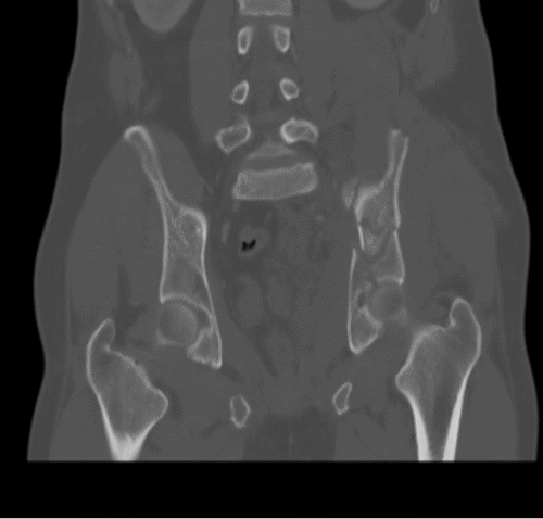 D) Coronal View