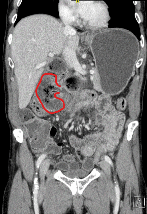 Note the perforated diverticulum in the second portion of the duodenum with a large associated abscess cavity outlined in red
