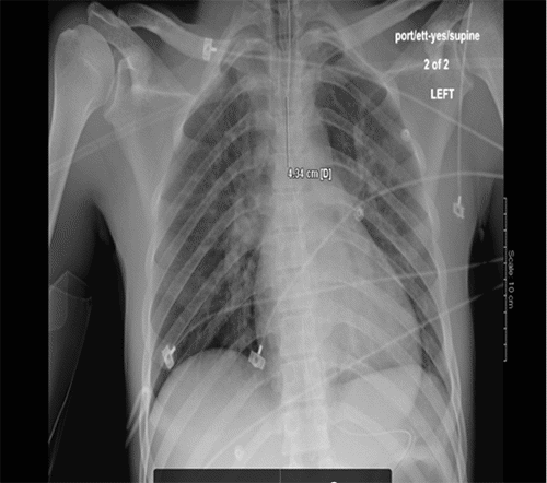 A) Initial CXR within ten minutes of arrival shows clear lung fields
