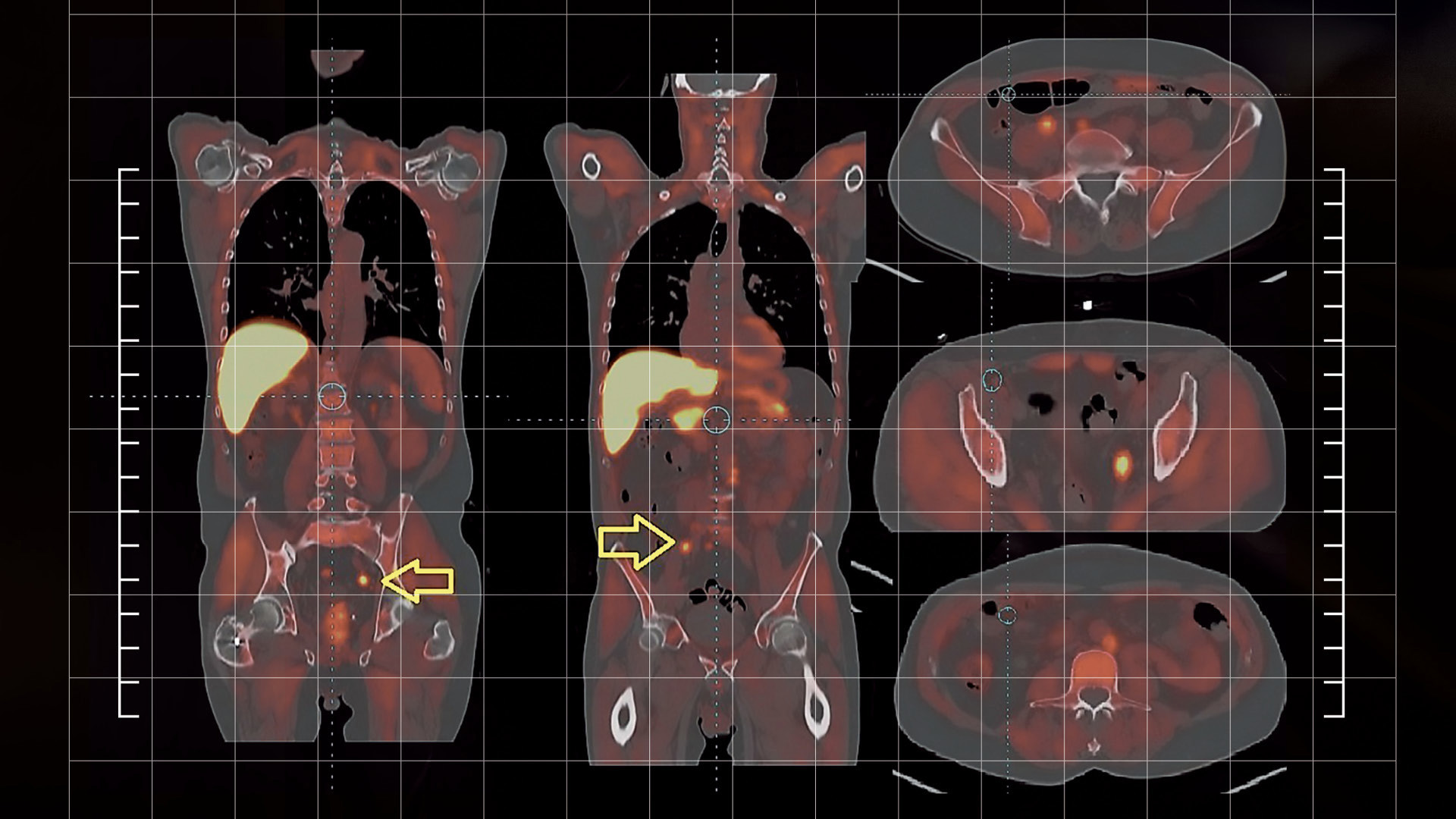 Advanced Imaging, Robotic Surgery Propel Prostate Cancer Management