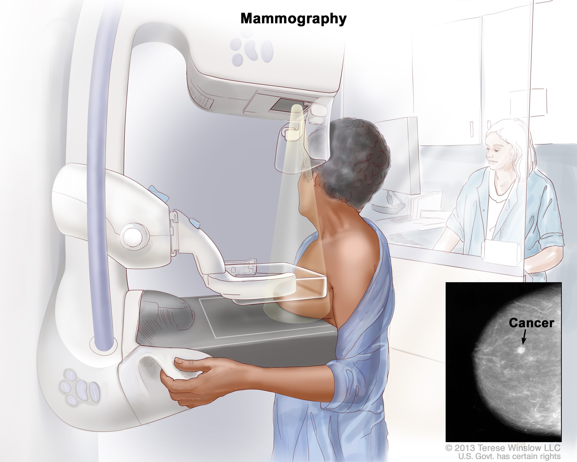 Screening mammogram