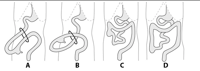 Figure 3. Developmental stages of midgut rotation. In A, the duodenum has completed a 90° counterclockwise rotation to position to the right of the superior mesenteric artery. In B, the duodenum has rotated another 90° counterclockwise. In C, the final the 90° counterclockwise rotation is completed by duodenum. The cecum continues to rotate and future to be ascending colon descends. In D, the normally rotated bowel is depicted.<sup>5</sup>