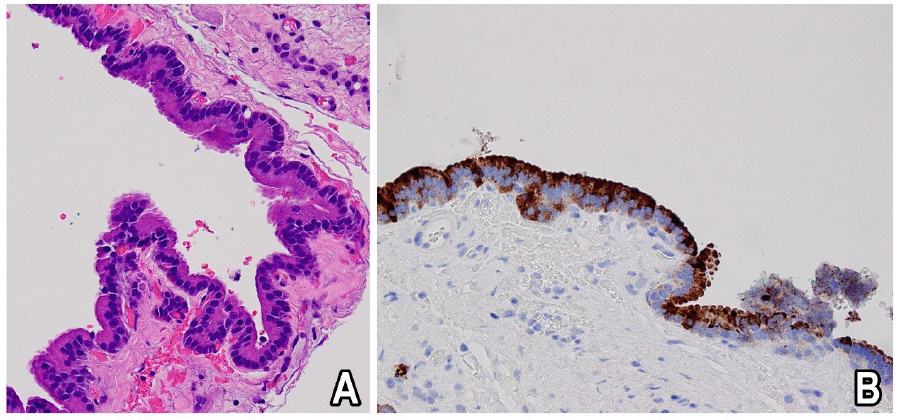 (A) Hematoxylin and eosin (H&E) stain demonstrates cyst lined by epithelium, showing acinar features with bright red apical granules (400x); and B) immunohistochemical stain shows chymotrypsin is positive within epithelium of cyst, confirming its acinar derivation (200x).