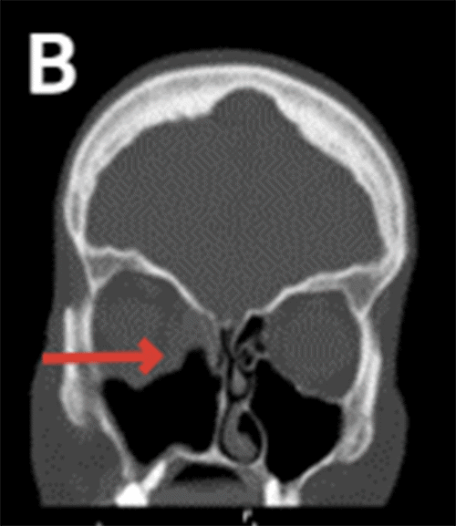 B) Arrow pointing at loss of right lamina papracea