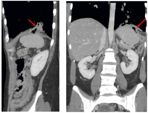 Image demonstrates fistulous communication between splenic flexure and left lower lobe bronchus with intact diaphragm
