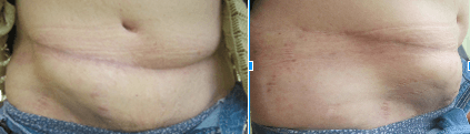 Figures 2 and 3. Recurrence and pain over the repair site causing a functional limitation (4/14/2016)