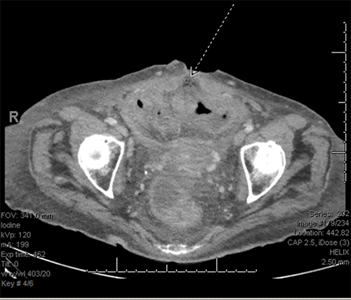 Arrow shows focal fluid and air locules communicating with the anterior midline surgical wound superficial to focally thickened and hyperemic colon