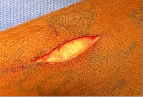 B) Completed skin incision down to subdermal/subcutaneous layers, using electrocautery with minimal bleeding and no significant thermal injury