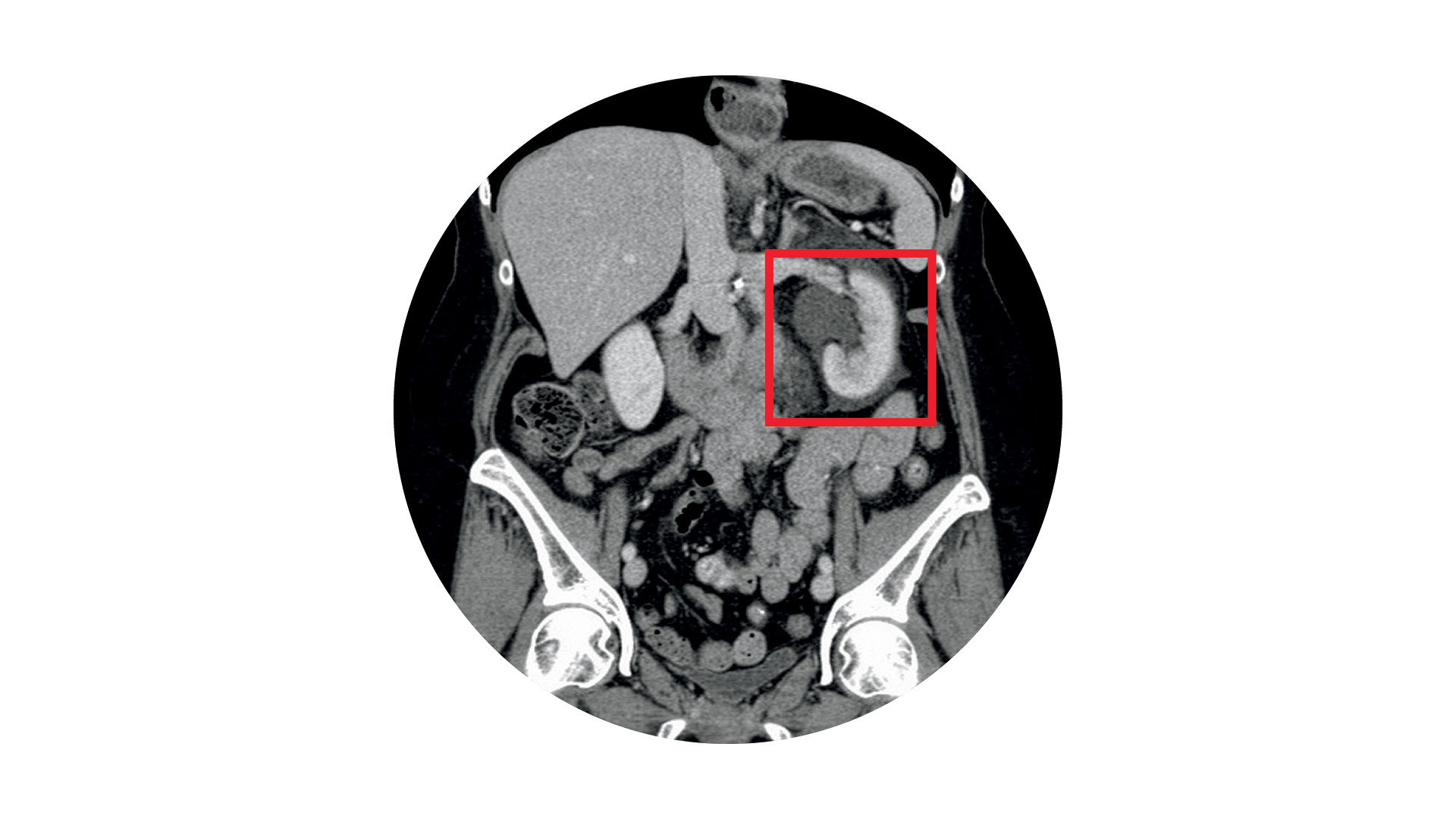 Rare Ureterosciatic Hernia Case Solved with Stenting, Robotic-Assisted Repair