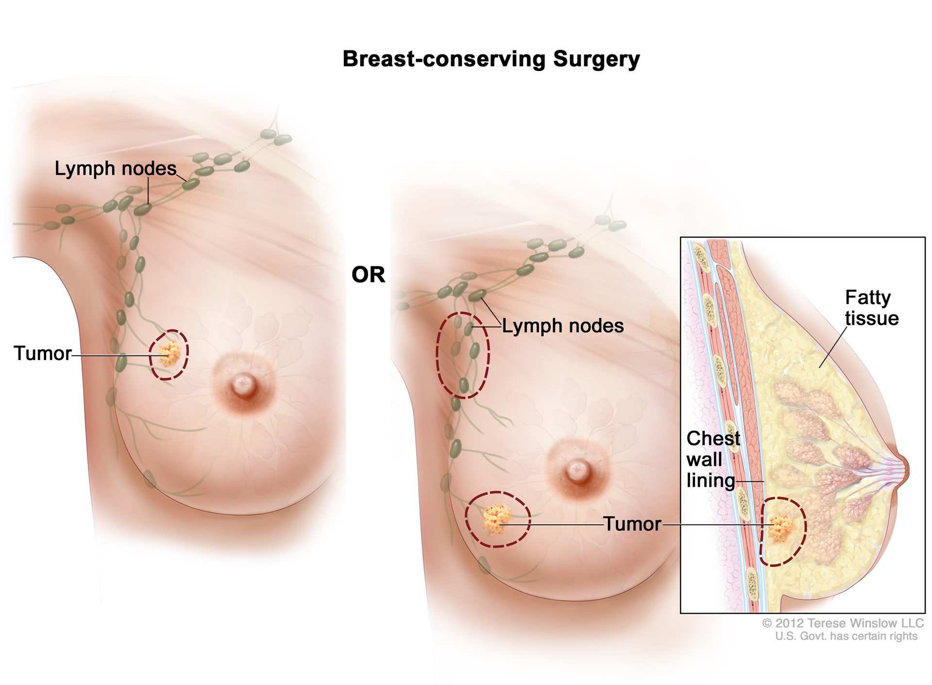 Breast-Conserving Surgery (Lumpectomy)
