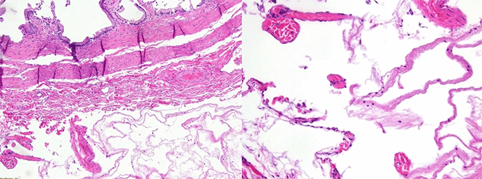 (L) Gallbladder wall and cystic duct margin. (R) Cystic structure consistent with lymphangioma identified on the serosal surface of the gallbladder.