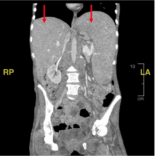 (B) Coronal view confirming hepatosplenomegaly.
