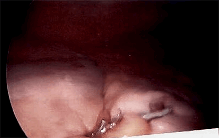 Figure 6. Laparoscopic view of left colon on right with cecum and staple line of appendectomy in the middle