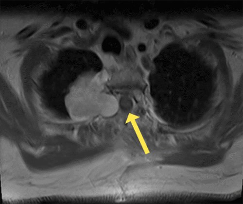 Axial T2-weighted image after the first stage of resection shows relief of mass effect on the spinal cord (arrow).