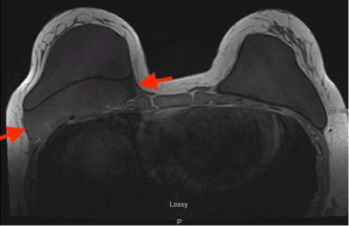 The image demonstrates a circumscribed tumor measuring 2.7 × 9.9 × 10.2 cm located posterior to the right subpectoral implant. Evidence of intercostal muscle invasion is present